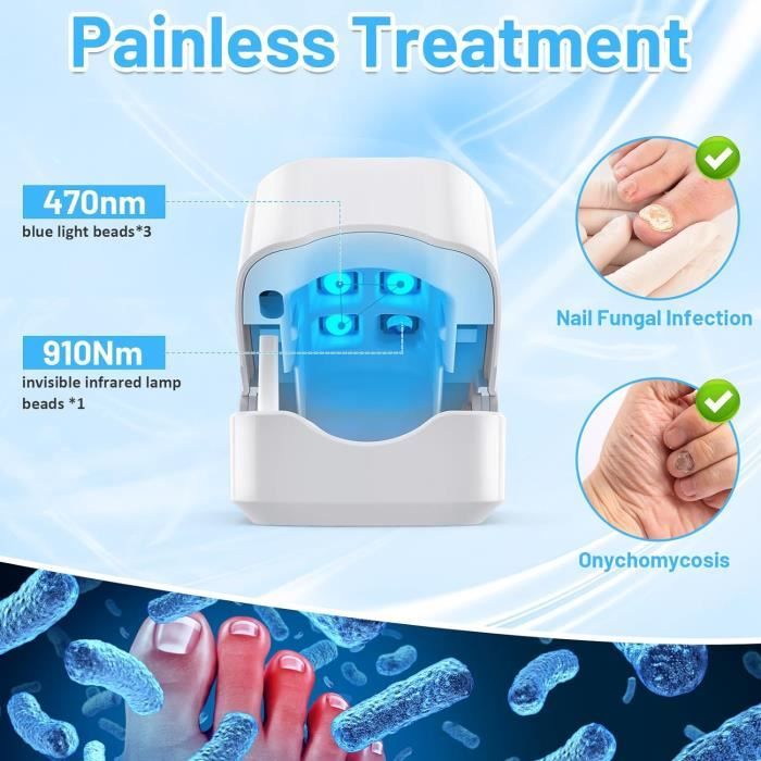 Laser Ongle Mycose Avis