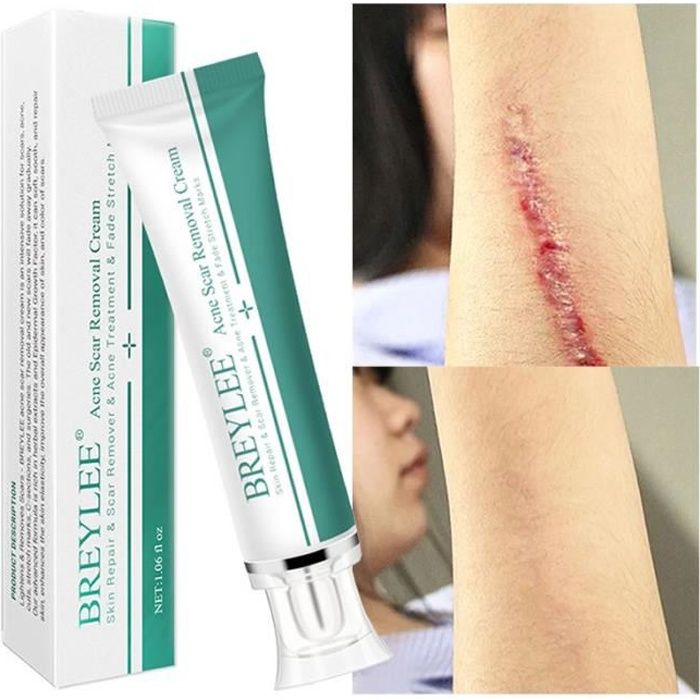 BREYLEE Acne Scar Removal Cream Face Pimples Spots Stretch Marks Cream