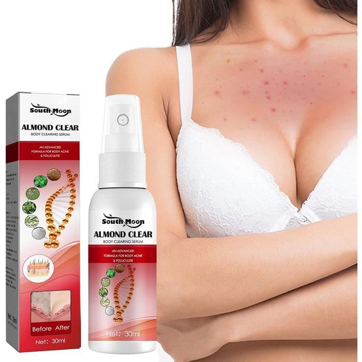 Savon Naturel VICTAGO Pour Acné, Eczéma Et Boutons Sévères - 80g à Base De Plantes