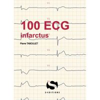 100 ECG infractus
