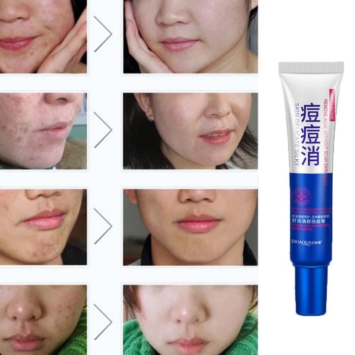 chaussure Prix de gros 2019 plutôt sympa Crème de soins de la peau efficace pour la peau Acné Spots Scar Removal Traitement des marques de taches@CNN70612432 chaussure Prix de gros 2019 plutôt sympa Crème de soins de la peau efficace pour la peau Acné Spots Scar Removal Traitement des marques de taches@CNN70612432