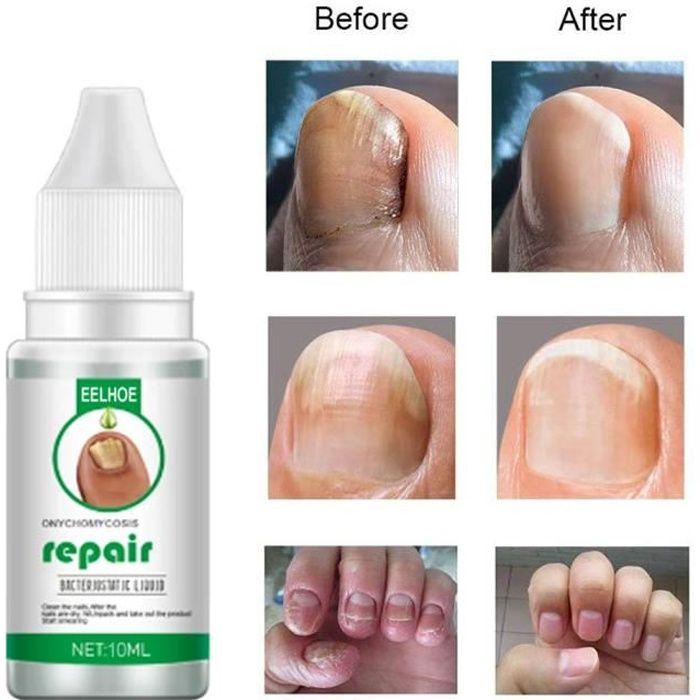 EELHOE Nail Repair Liquide Mains et Pieds Onychomycose Soin Réparation