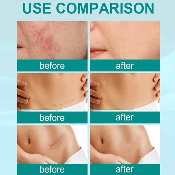 Scar Removal Spray 2023 New, Scar Remove Medical Grade Scar Spray, Scar  Removal Advanced Scar Spray for Stretch Marks Removal - Cdiscount Au  quotidien