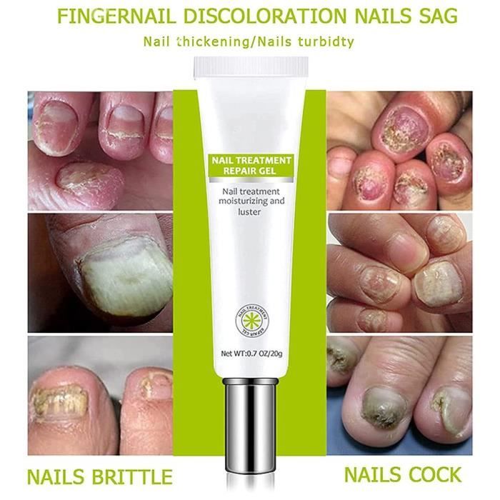 Drfeify soin des ongles des pieds Crème de soin des ongles pour craqueler, rugosité, décoloration, fragilité, soins hygiene pieds