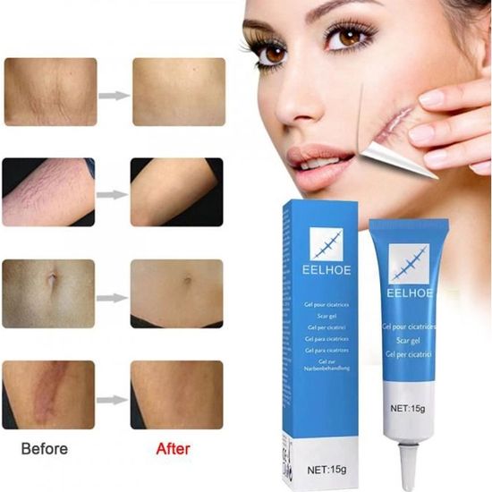 Crème Cicatrice,Crème AntiCicatrices Nouvelles et Anciennes, abdominoplastie, chéloïde