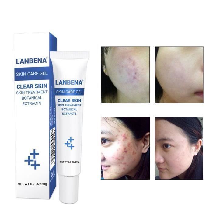 L'acné Scar Removal crème peau réparation visage crème acné tache 20ml B0BFD