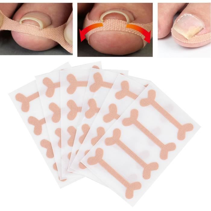 Cuque pansement anti-douleur 24 pièces Correction des ongles incarnés Bandage Soulagement de la douleur Paronychia Traitement