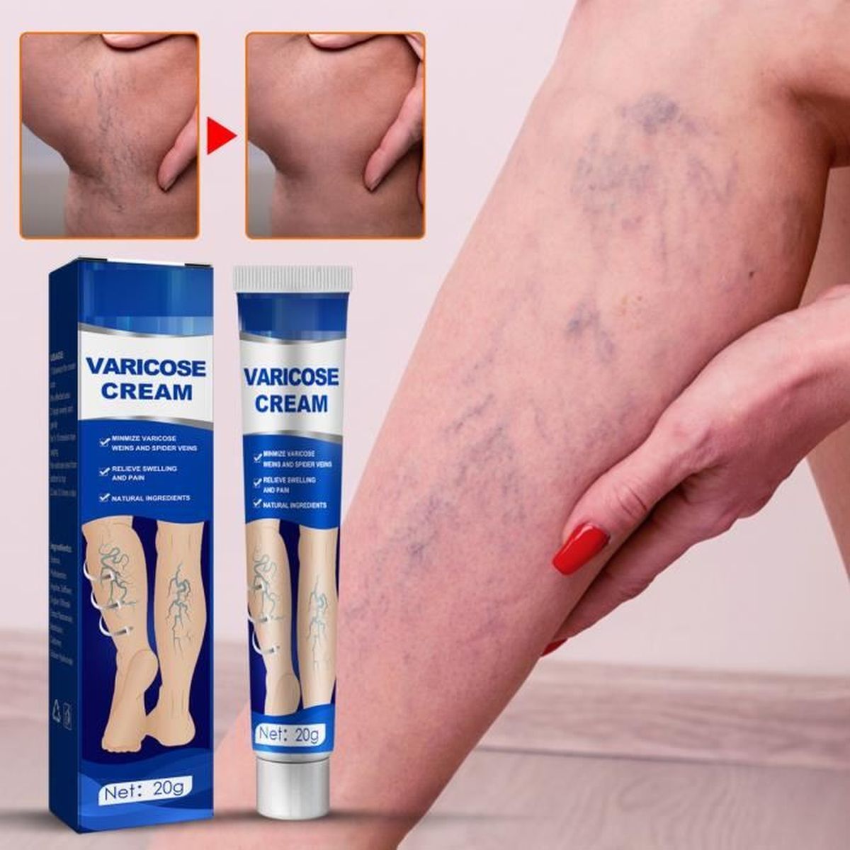 Crème Contre Les Varices,Crème Contre Les Varices pour Les Jambes Pommade Contre Les Varices