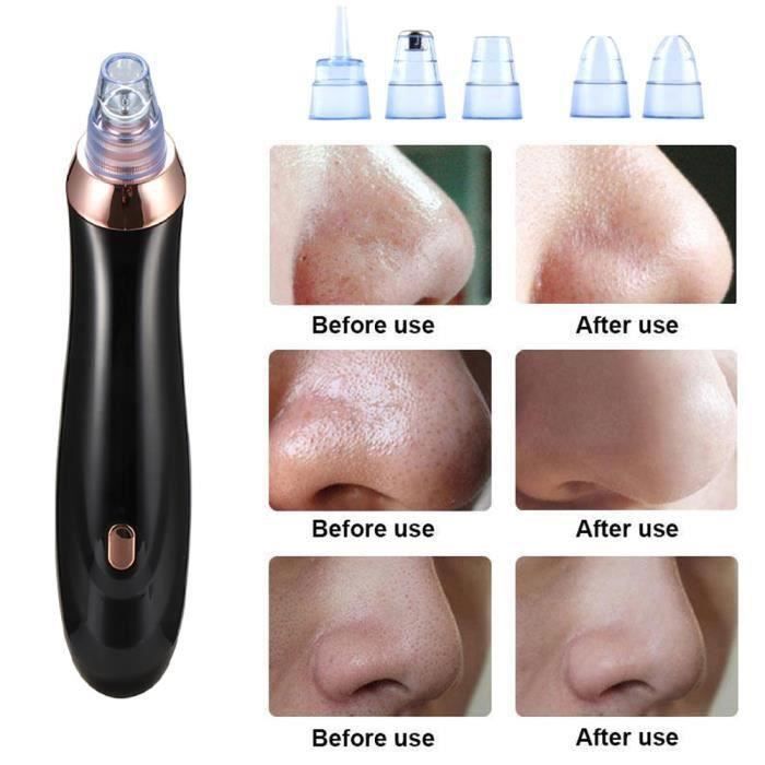 Aspirateur à Points Noirs Hallicare – Soin Visage Pour Acné Et Imperfections, Neuf