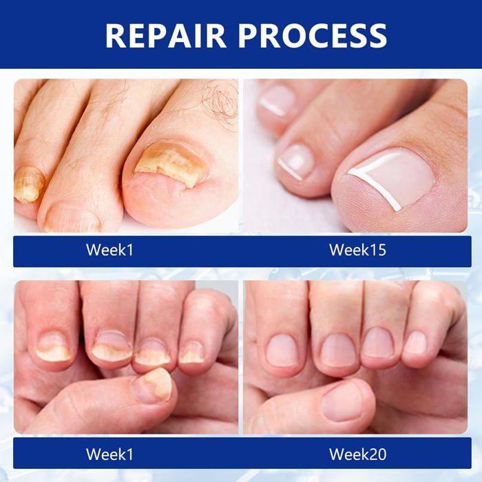 30Ml Ongles Réparateurs, Soin Ongles Des Pieds, Favorise La Repousse D — free download
