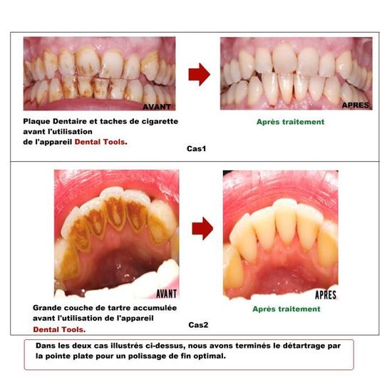 Kit Anti Tartre Dentaire Detartreur Dents Pro Elimination Plaque Dentaire Taches Cafe The Par Vibration Et Blanchiment Cdiscount Au Quotidien