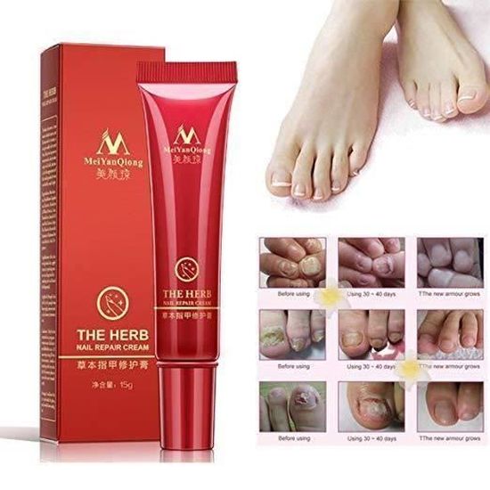 Me493 Mycose Ongle Traitement Aux Plantes Antifongique Reparatrice De Pieds Mains Facile Et Rapide 15g Cdiscount Puericulture Eveil Bebe Me493 Mycose Ongle Traitement Aux Plantes Antifongique Reparatrice De Pieds Mains Facile Et Rapide 15g Cdiscount Puericulture Eveil Bebe
