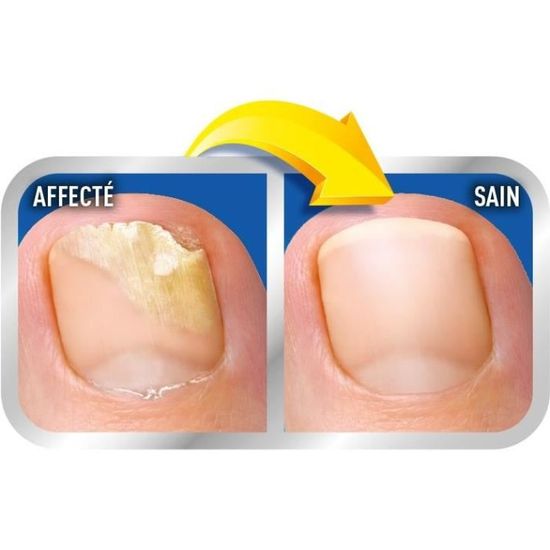 Scholl Solution 2 En 1 Ongles Abimes Par Mycoses Cdiscount Au Quotidien Scholl Solution 2 En 1 Ongles Abimes Par Mycoses Cdiscount Au Quotidien