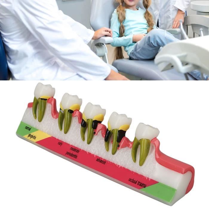 Modèle de progression de la maladie parodontale - Dental Project