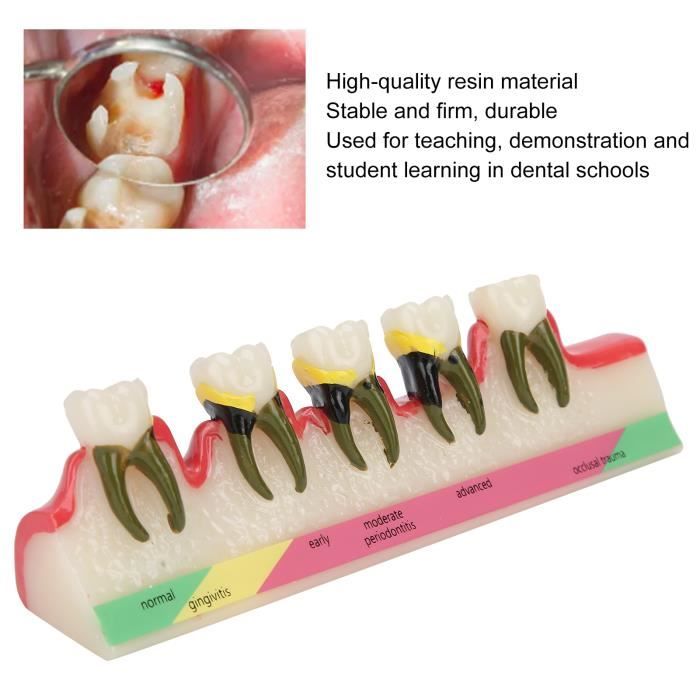LA MALATTIA PARODONTALE – Studio Dentistico Dr. Andrea Viaggi - Foto 6