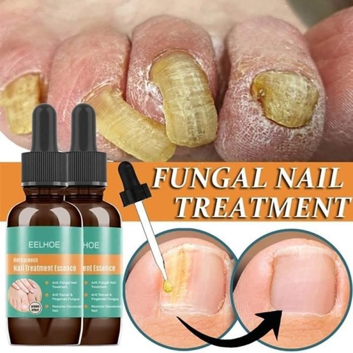 Vernis A Ongles Contre La Mycose Des Ongles Soin Et Traitement Des Ongles Vernis A Ongles Soin Des Ongles Pour Des Pieds Et Des Cdiscount Au Quotidien