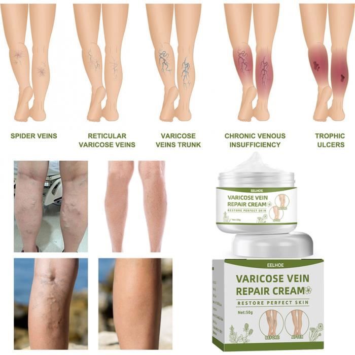Gel pour les jambes Crème réparatrice des varices à base d'extraits de — free download