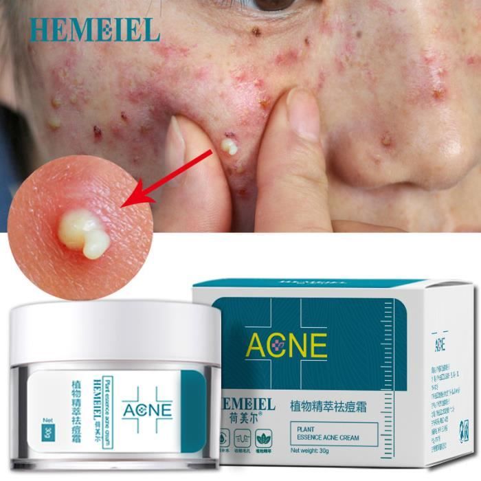 HEMEIEL Traitement pour l'acné Crème le visage Nature Plants Essence Pimple Enlèvement des cicatrices Cdiscount Au quotidien