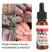 Solution de traitement fongique des ongles Renouvellement fongique des ongles Traitement des champignons hygiene des - Pwshymi