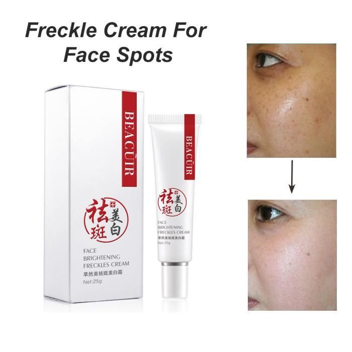 Crème anti-taches pour hyperpigmentation, taches de rousseur, mélasma