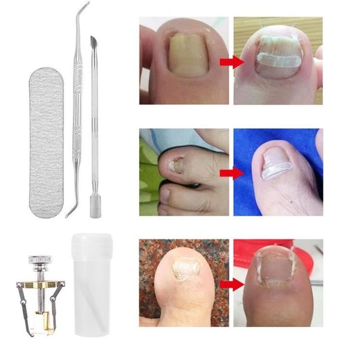 6pcs Ongles Incarnes Pedicure Correcteurs D Ongles Incarne Kit En Acier Inoxydable Pour Cuticules Envahies Cdiscount Au Quotidien