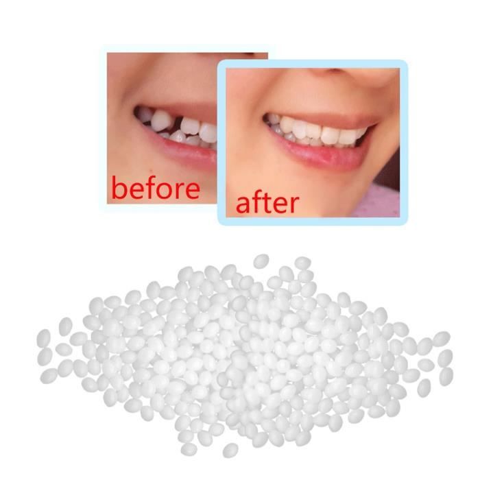 Couronne de Fausses Dents en Résine, Couronne Temporaire Dentaire, Kit de  Réparation de Dents Facettes de Dents Soins Bucco-dentaires Multi-usages
