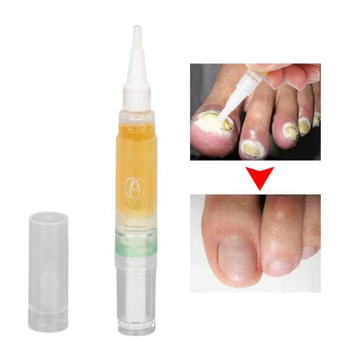 Sérum fongique des ongles Sérum de traitement des champignons des ongles Soin doux Sérum de traitement de réparation des En Stock