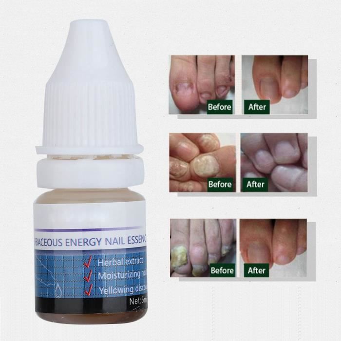 Qiilu Traitement des ongles 5 ml de traitement de Leuonychia puissant Anti-champignon extrait de plantes à base de plantes Solution
