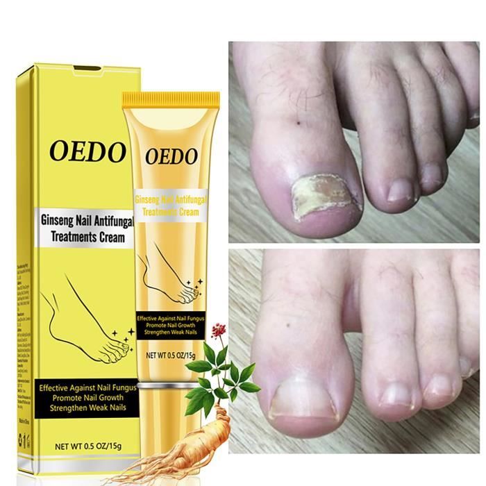 Oedo Creme Fongique Pour Les Ongles Soins Des Pieds Traitement Antifongique Desherbage Mycose Des Ongles 16 Cdiscount Au Quotidien