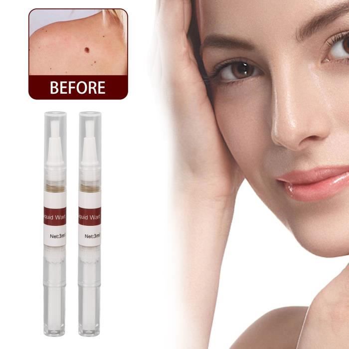 verrues noires sur le visage