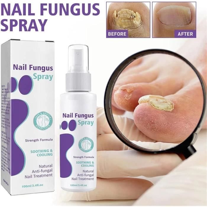 Laser Treatment for Nail Fungus – What You Need to Know | Foot & Ankle