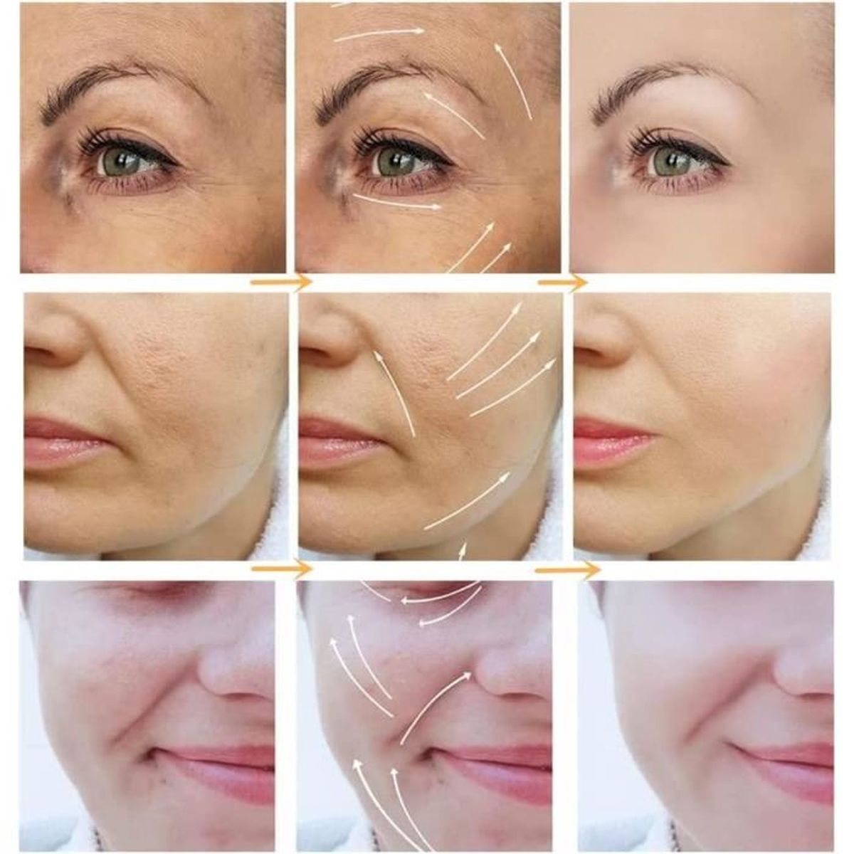 Fils De Soie Collagène Avant Après Sculpture de Fil sans collagène et sans Aiguille Fil de protéine de d'or  Face Lifting Bande pour Le raffermissement de la Peau - Cdiscount Au  quotidien