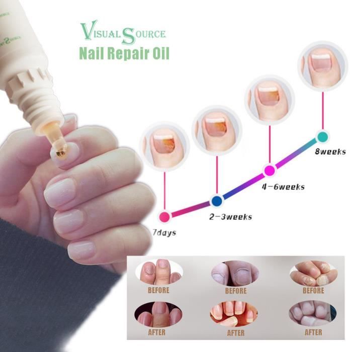 Vernis à ongle Stylo de traitement liquide de réparation des ongles 10ML Onychomycose Paronychia Anti fongique Nai gh2279