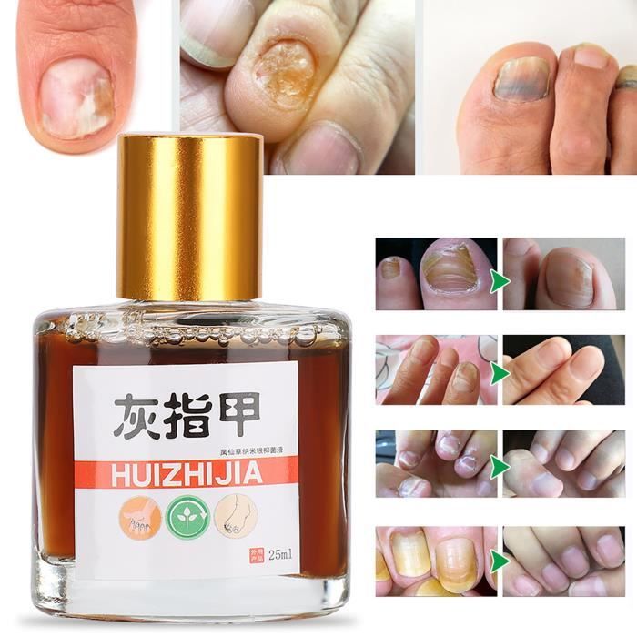 EBTOOLS Liquide antifongique Anti Fungus Liquid Fungal Nail Treatment