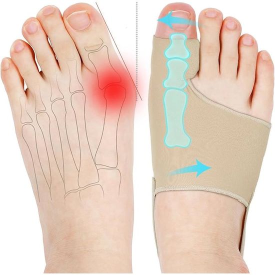 Hallux algus Schiene, Couleur de peau Écarteurs de doigts Hallux algus ...