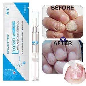 Mycose Ongle