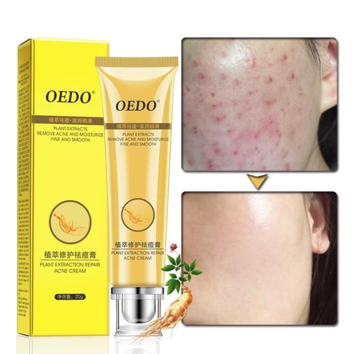20g Visage Soins de la peau Acné Crème Huile Contrôle Acné Produits Crème Visage Beauté