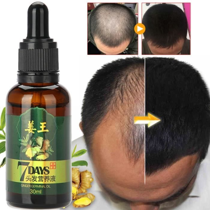chute de cheveux homme