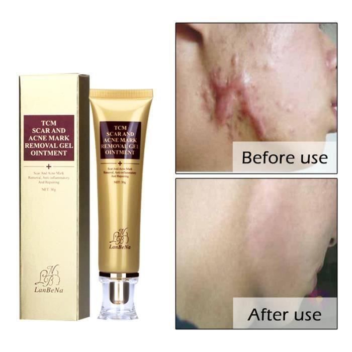 Crème Cicatrice Traitement Efficace Visage Soins de la peau Crème Anti acné
