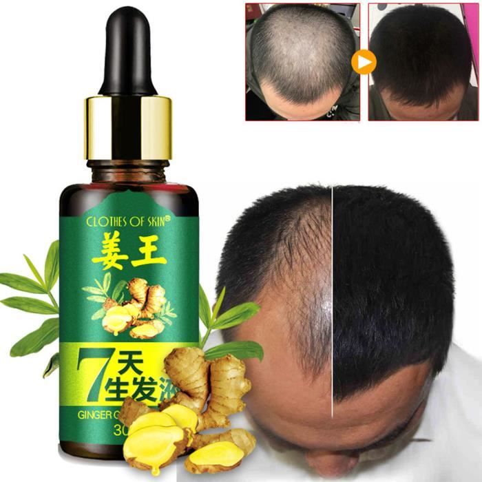 Traitement naturel de perte de cheveux de croissance rapide de cheveux