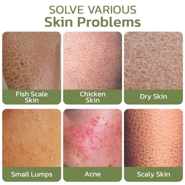 Keratose-Creme - 2x30 Ml, Glättet Raue Haut Mit Vitamin E, Sanftes Peeling Für Tägliche Pflege