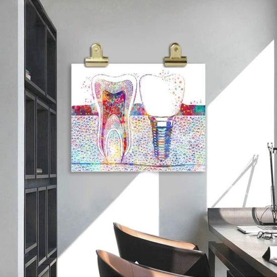 Toile Dentaire Dent Implant Aquarelle 60x80 Cm – Décoration Murale Clinique Dentaire, Cabinet & Bureau Dentiste
