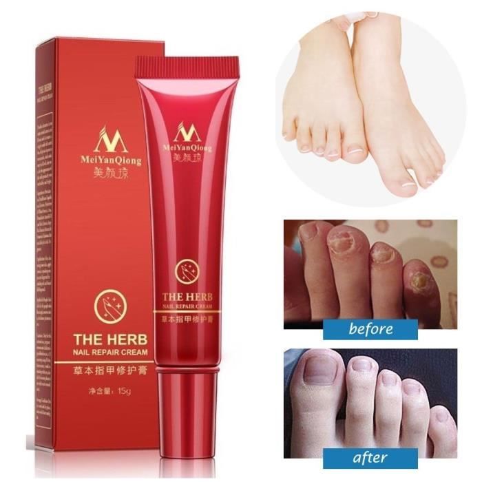 Fongiques Traitement Ongle Abimés Main Et Pied Anti Fongiquecrème Aux Herbes Chinoiseefficace Contre La Mycose Dongle