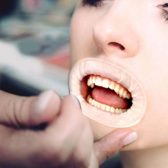 Écarteur pratique dentaire de barrage en caoutchouc d'ouvreur de bouche de 1pc pour l'hôpital SOIN BLANCHIMENT DES DENTS