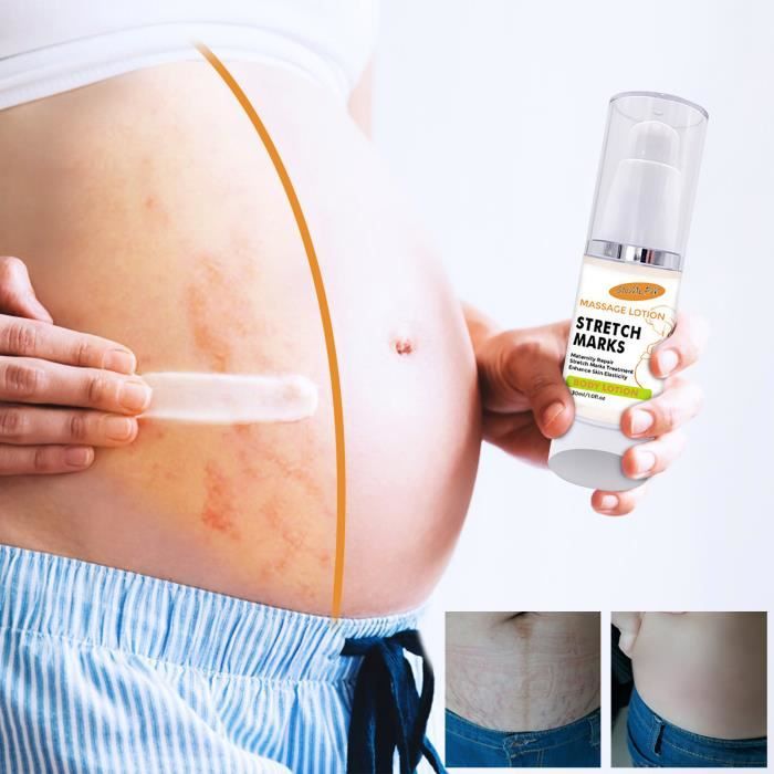 Crème Réparatrice Cicatrice Femme Enceinte Vergetures Lotion Hydratante Soin Corps 30Ml CZ10412