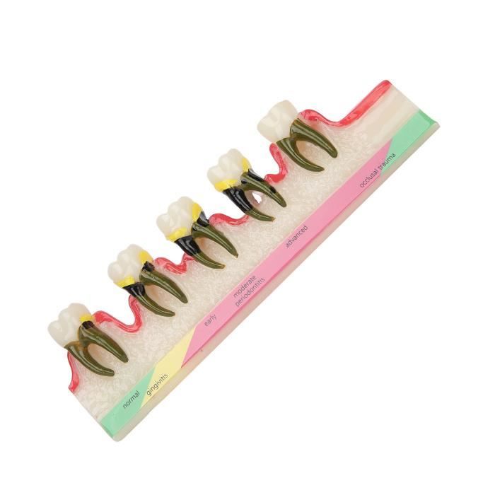 Modèle Dentaire D'entraînement - Caries, Maladie Parodontale (dentoforme, Neuf)