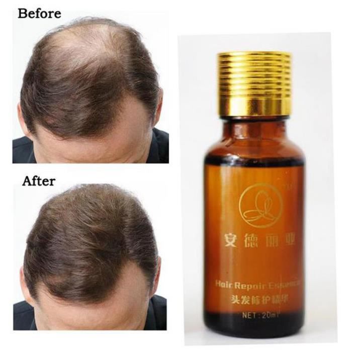 20ml pousse des cheveux Traitement,Anti perte L'huile essentielle de