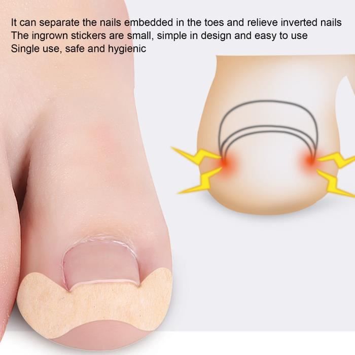 Patch d'ongle 10 feuilles outil de Correction des ongles incarnés enlèvement correction correction pédicure outil de HB014