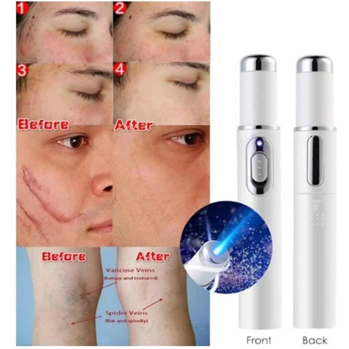 Laser Varice Achat Vente Pas Cher