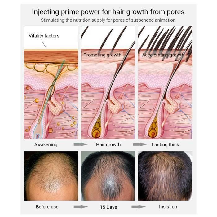 LANBENA Hair Growth Essence Spray Product Preventing Baldness Consolidating Anti Hair Loss Nourish Roots Easy To Carry Hair Care - Cdiscount Au quotidien LANBENA Hair Growth Essence Spray Product Preventing Baldness Consolidating Anti Hair Loss Nourish Roots Easy To Carry Hair Care - Cdiscount Au quotidien